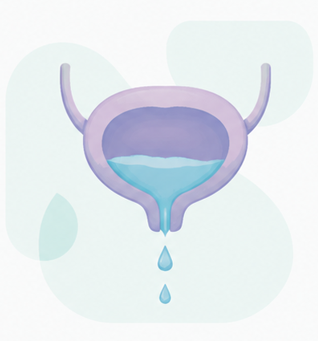 Incontinencia urinaria 1 Ilustracion de vejiga con incontinencia urinaria