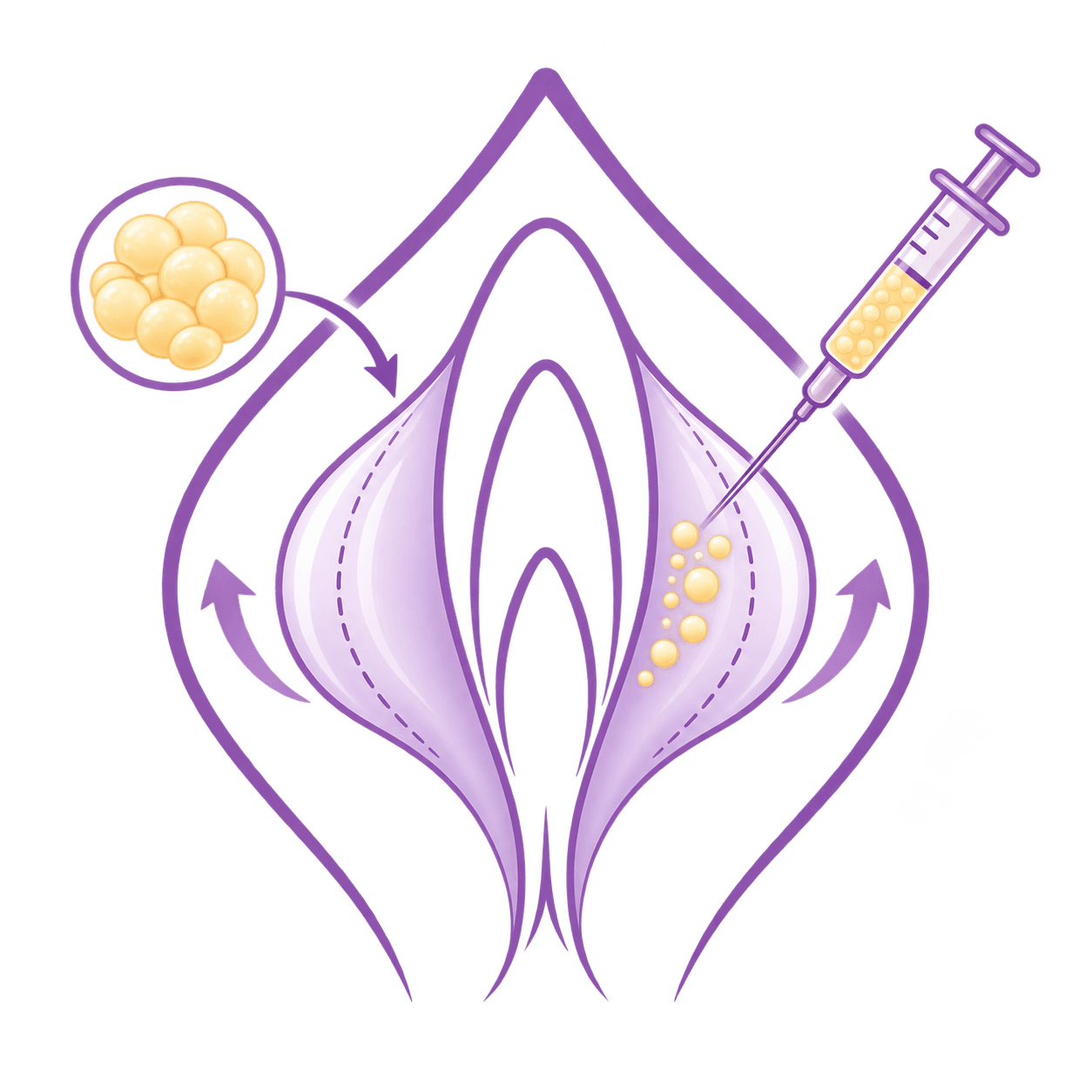Lipotransferencia a labios mayores